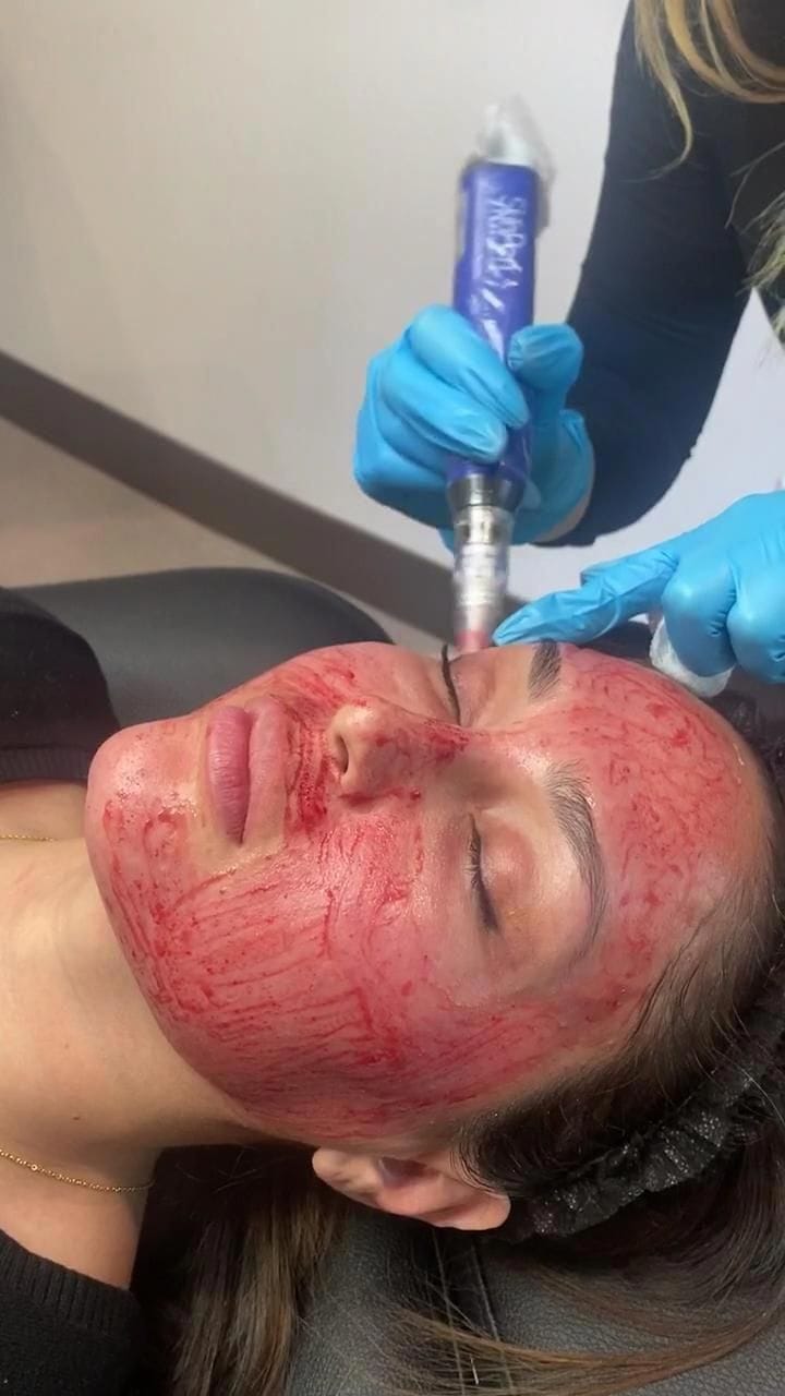 جلسة الديرمابن (Dermapen / Microneedling) - صورة 1