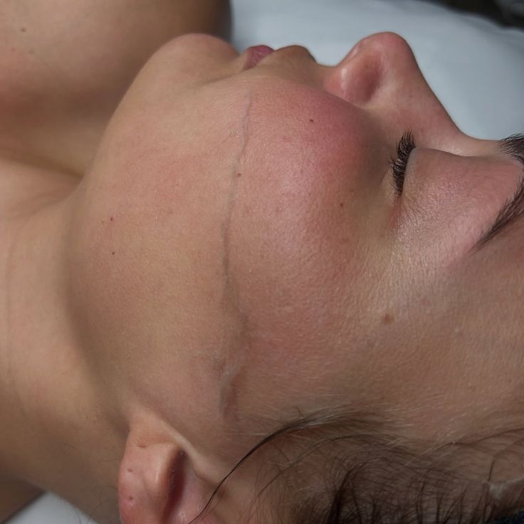 جلسة الديرما بلانينج (Dermaplaning) - صورة 3