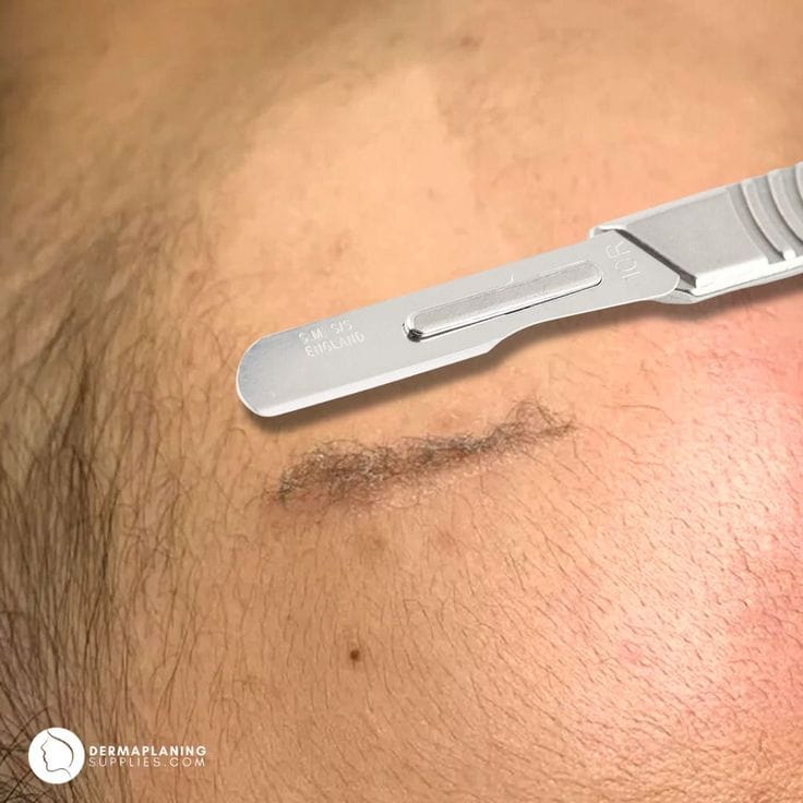 جلسة الديرما بلانينج (Dermaplaning) - صورة 4