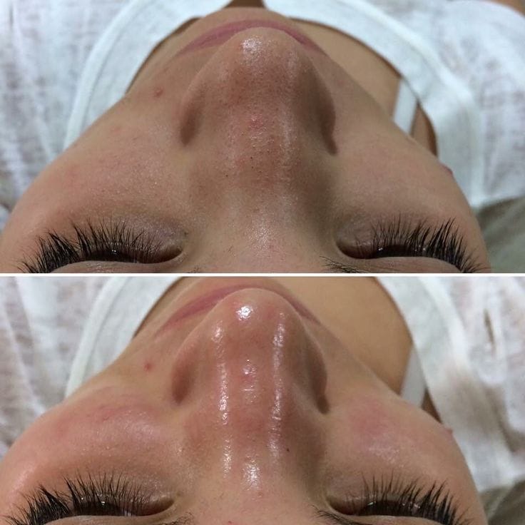 جلسة الهيدرافيشل (Hydrafacial) - صورة 3